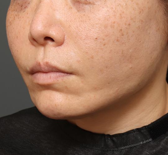 40代女性のチークリフト・フェイスリフト After 症例写真