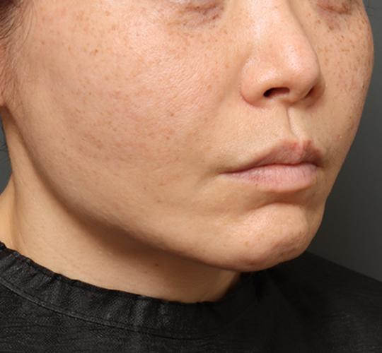 40代女性のチークリフト・フェイスリフト After 症例写真