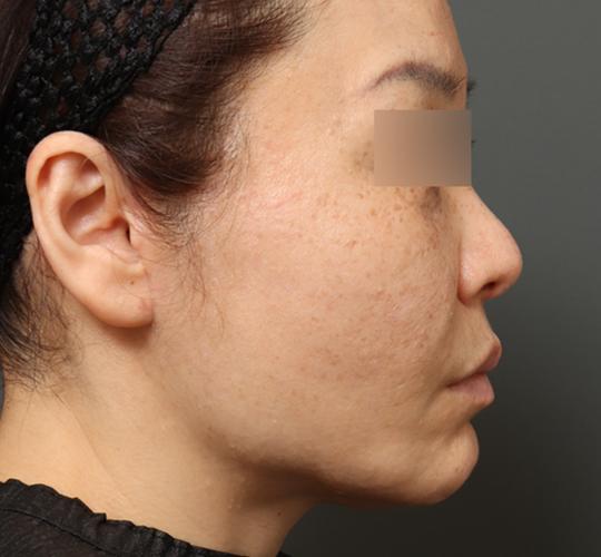 40代女性のチークリフト・フェイスリフト After 症例写真