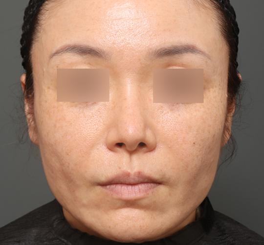 40代女性のチークリフト・フェイスリフト Before 症例写真