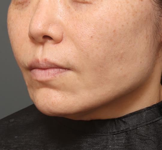 40代女性のチークリフト・フェイスリフト Before 症例写真