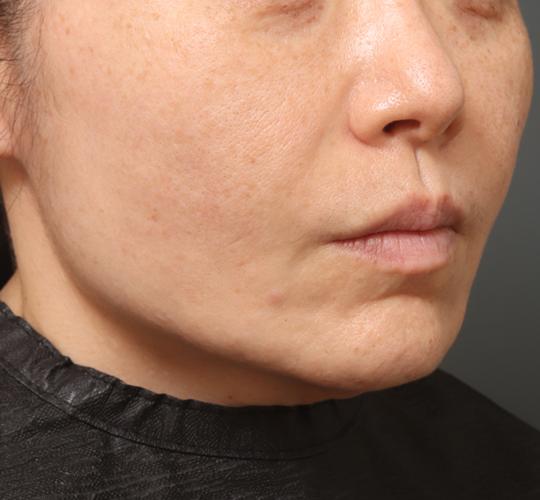 40代女性のチークリフト・フェイスリフト Before 症例写真