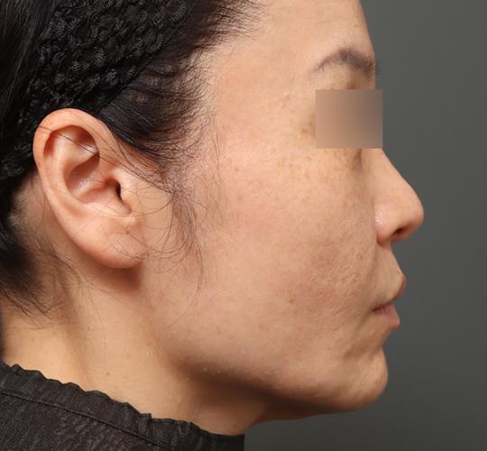 40代女性のチークリフト・フェイスリフト Before 症例写真