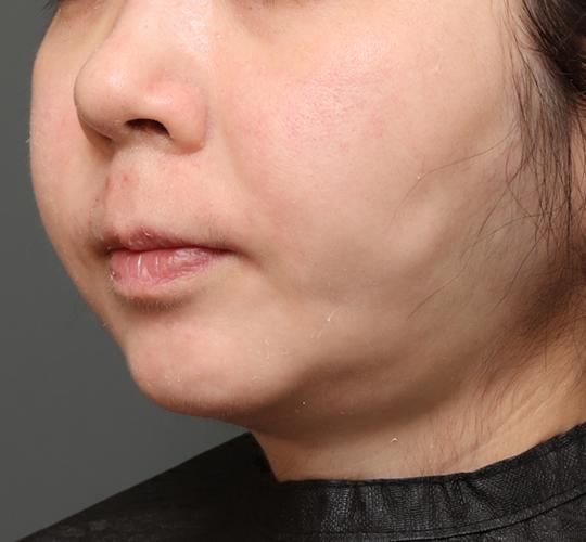 30代女性のフェイスタイト After 症例写真