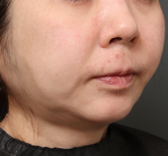 30代女性の脂肪吸引・痩身 After 症例写真
