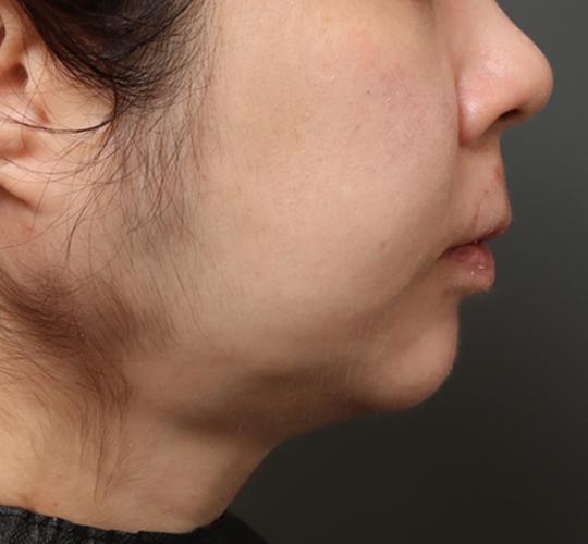 30代女性のフェイスタイト After 症例写真
