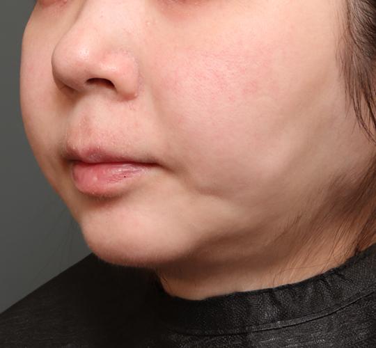 30代女性のフェイスタイト Before 症例写真