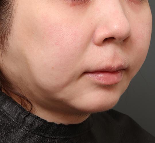 30代女性の脂肪吸引・痩身 Before 症例写真