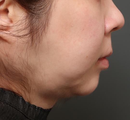 30代女性のフェイスタイト Before 症例写真