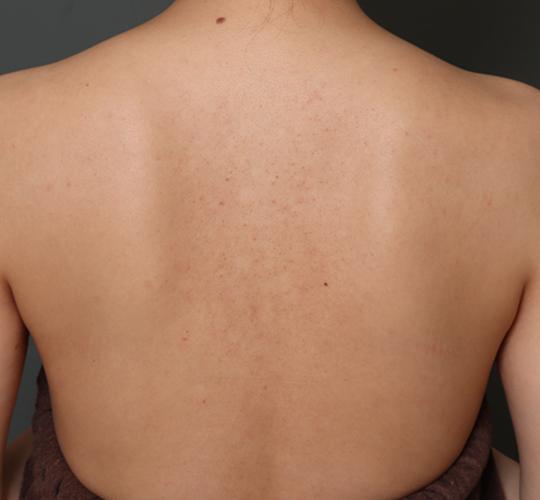 30代女性の美肌治療 After 症例写真