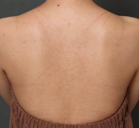 30代女性の美肌治療 Before 症例写真