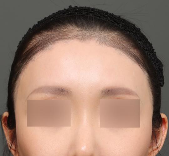 30代女性の額縮小 After 症例写真