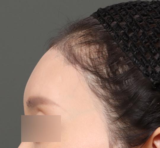 30代女性の額縮小 After 症例写真