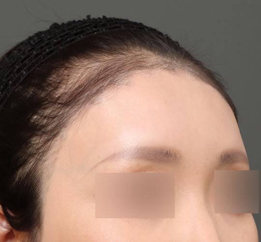 30代女性の額縮小 After 症例写真