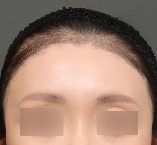 30代女性の額縮小 After 症例写真