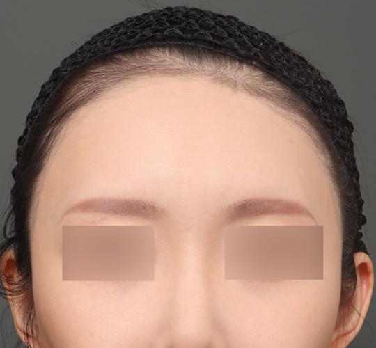 30代女性の額縮小 Before 症例写真