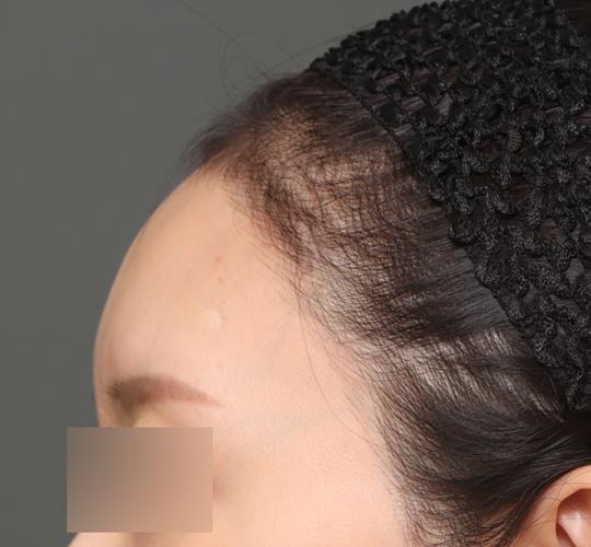 30代女性の額縮小 Before 症例写真