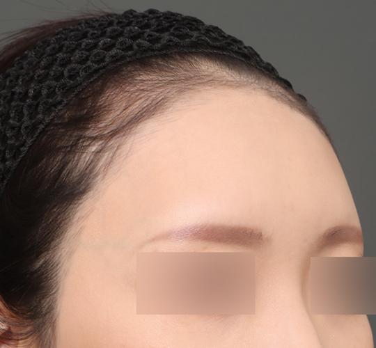 30代女性の額縮小 Before 症例写真