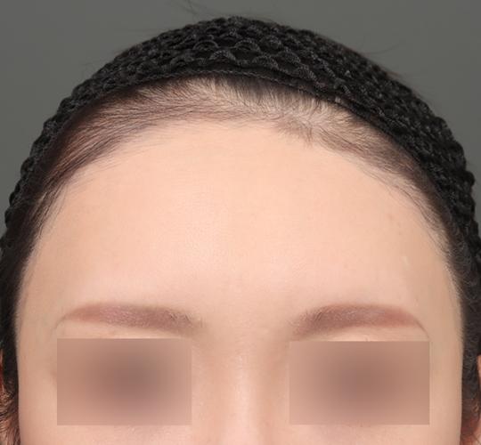 30代女性の額縮小 Before 症例写真