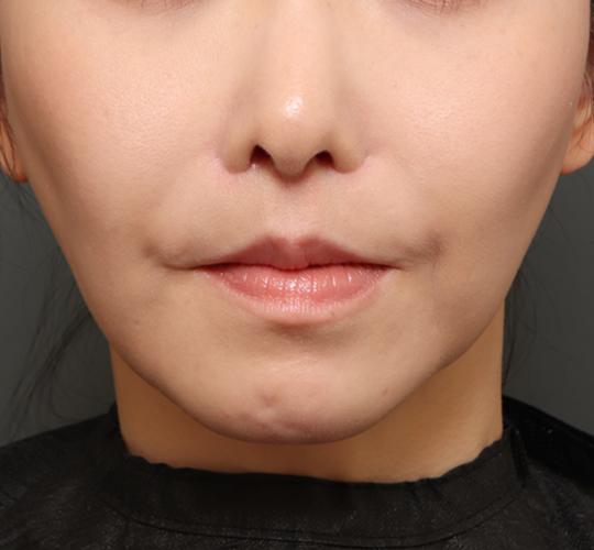 30代女性の唇・口元の整形 After 症例写真