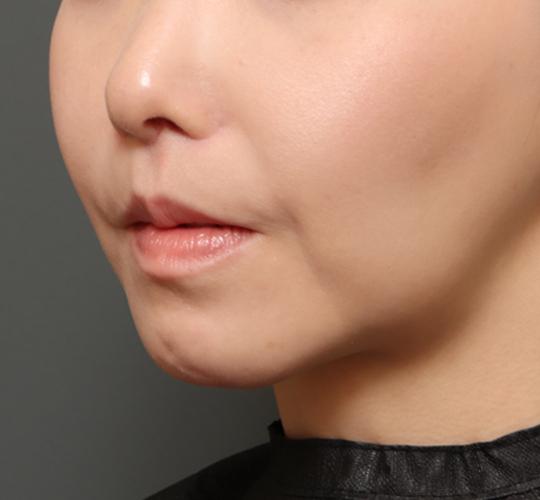 30代女性の人中短縮(リップリフト) After 症例写真