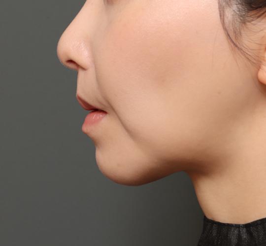 30代女性の人中短縮(リップリフト) After 症例写真