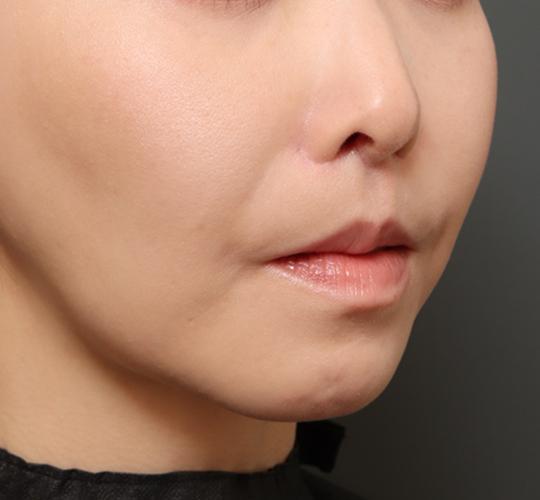 30代女性の人中短縮(リップリフト) After 症例写真