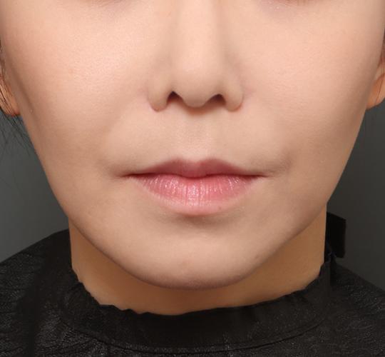 30代女性の唇・口元の整形 Before 症例写真