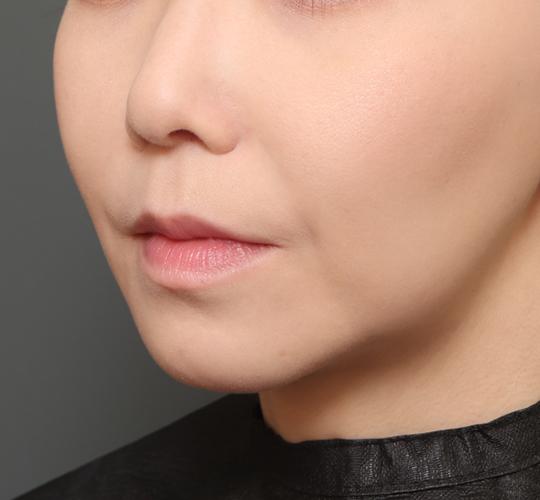 30代女性の人中短縮(リップリフト) Before 症例写真