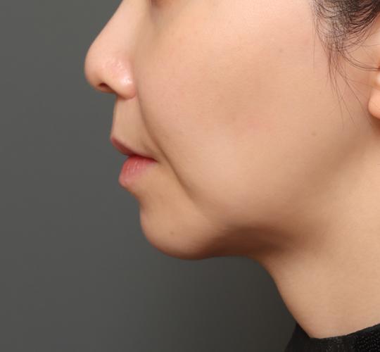 30代女性の人中短縮(リップリフト) Before 症例写真