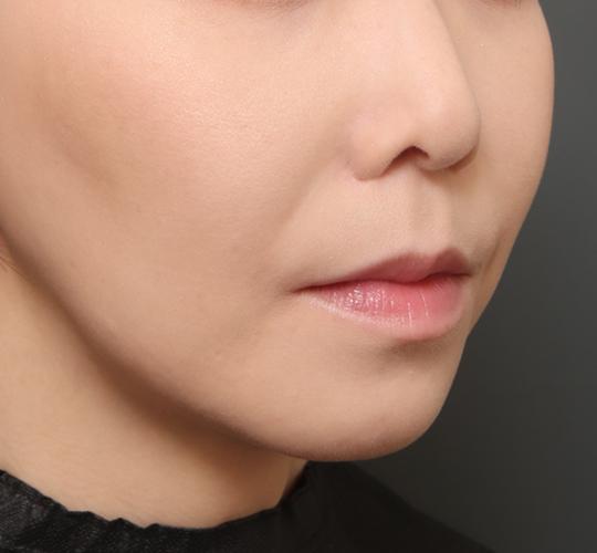 30代女性の人中短縮(リップリフト) Before 症例写真