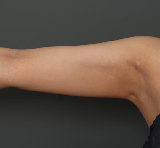 30代女性の脂肪吸引 After 症例写真