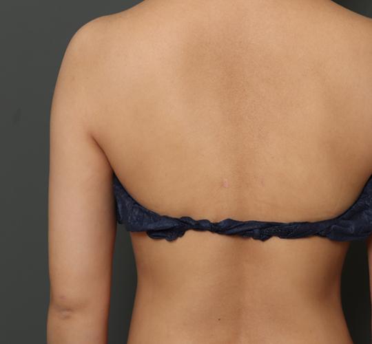 30代女性の脂肪吸引 After 症例写真