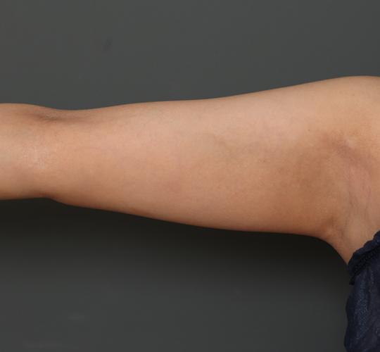 30代女性の脂肪吸引 Before 症例写真