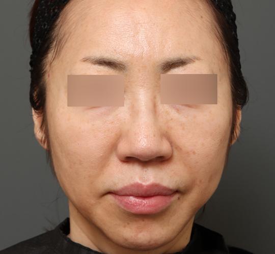 50代女性のクラリティフォトフェイシャルプラス After 症例写真