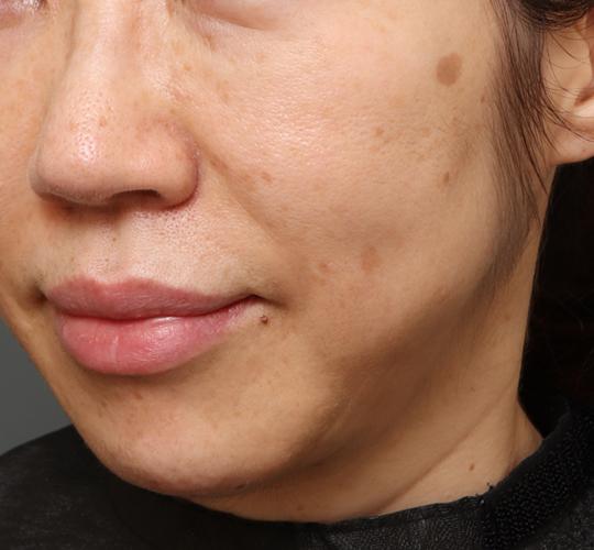 50代女性のシミ・そばかす After 症例写真