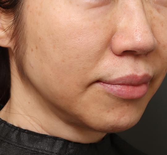 50代女性のクラリティフォトフェイシャルプラス After 症例写真