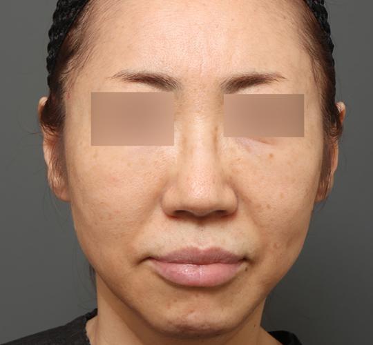 50代女性のクラリティフォトフェイシャルプラス Before 症例写真