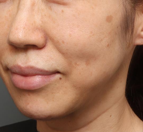 50代女性のシミ・そばかす Before 症例写真