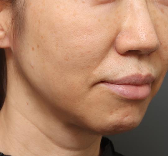 50代女性のクラリティフォトフェイシャルプラス Before 症例写真