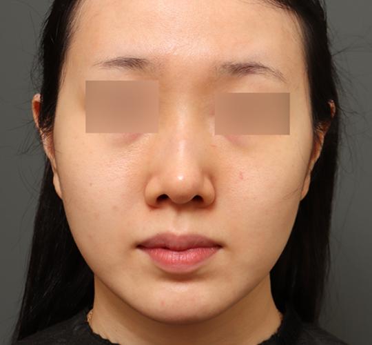 30代女性のクラリティフォトフェイシャルプラス After 症例写真