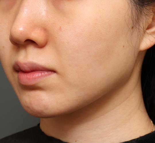 30代女性の毛穴・黒ずみ After 症例写真