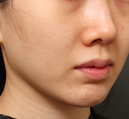 30代女性のクラリティフォトフェイシャルプラス After 症例写真