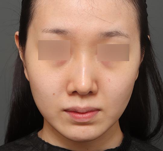 30代女性のクラリティフォトフェイシャルプラス Before 症例写真