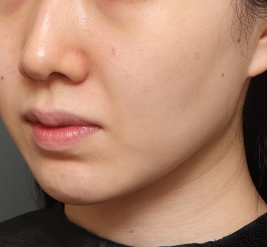 30代女性の毛穴・黒ずみ Before 症例写真