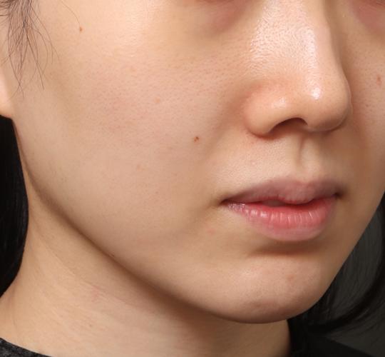 30代女性のクラリティフォトフェイシャルプラス Before 症例写真