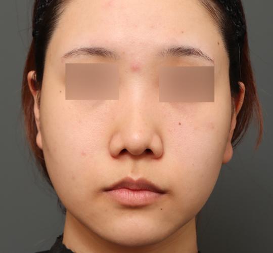 20代女性のクラリティフォトフェイシャルプラス After 症例写真