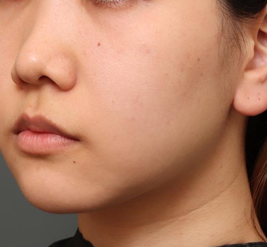 20代女性のシミ・そばかす After 症例写真