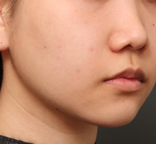 20代女性のクラリティフォトフェイシャルプラス After 症例写真