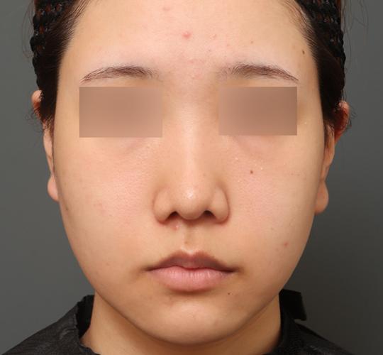 20代女性のクラリティフォトフェイシャルプラス Before 症例写真